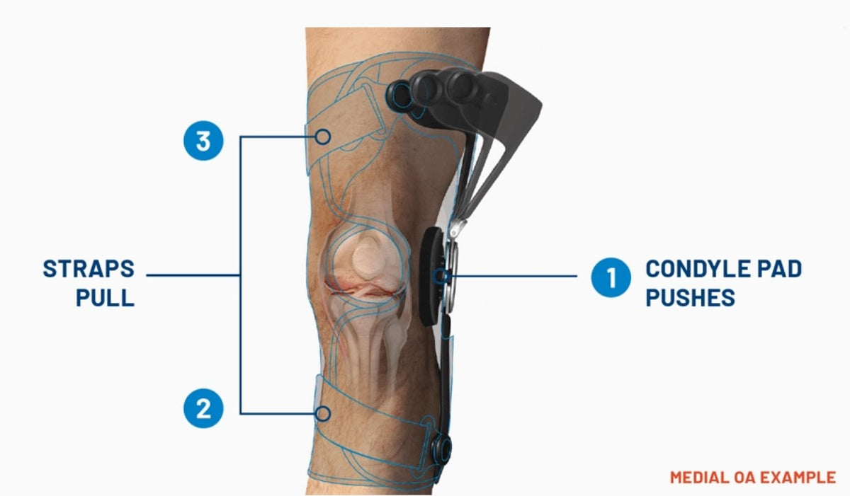 TRUlign OA Knee Brace