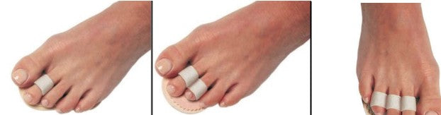 Budin Toe Straightener Splint
